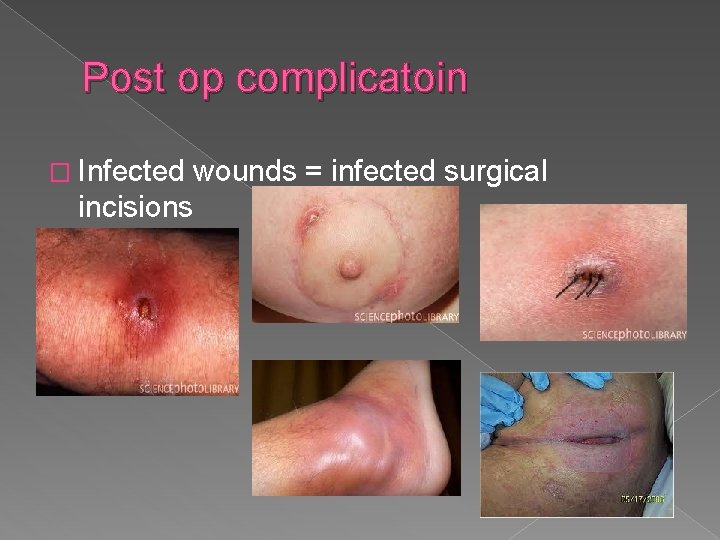 Post op complicatoin � Infected wounds = infected surgical incisions 