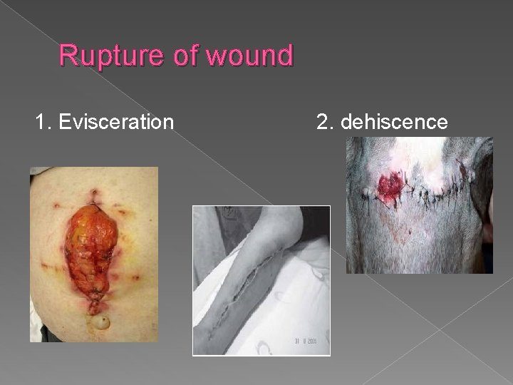 Rupture of wound 1. Evisceration 2. dehiscence 