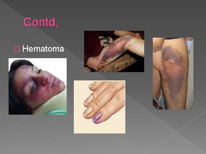 Contd, � Hematoma 