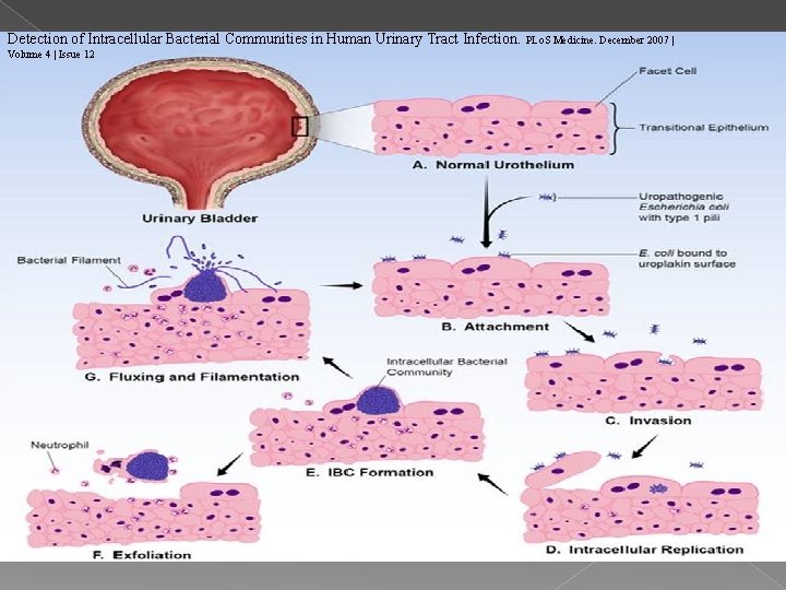 Detection of Intracellular Bacterial Communities in Human Urinary Tract Infection. PLo. S Medicine. December