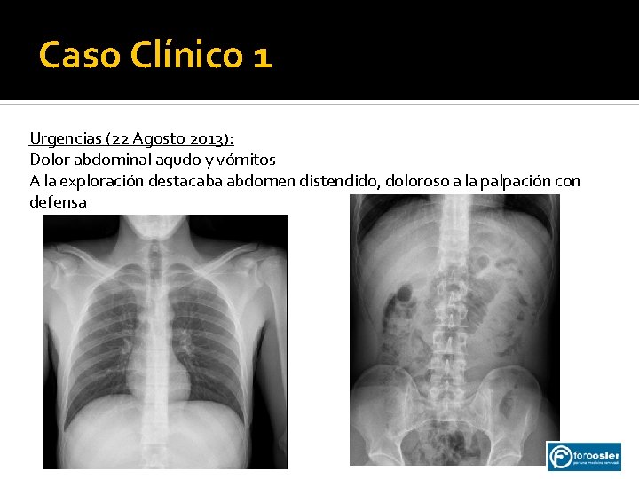 Caso Clínico 1 Urgencias (22 Agosto 2013): Dolor abdominal agudo y vómitos A la