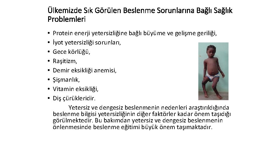 Ülkemizde Sık Görülen Beslenme Sorunlarına Bağlı Sağlık Problemleri • • Protein enerji yetersizliğine bağlı