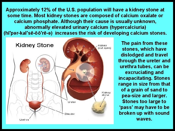 Approximately 12% of the U. S. population will have a kidney stone at some