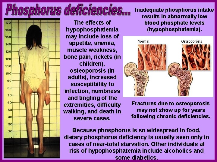 The effects of hypophosphatemia may include loss of appetite, anemia, muscle weakness, bone pain,