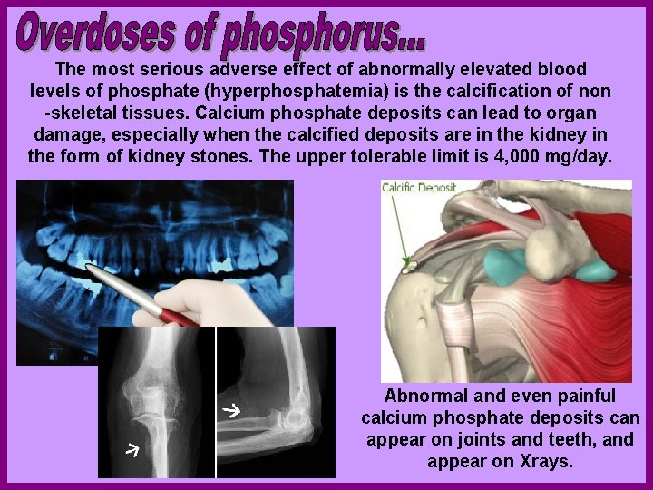 The most serious adverse effect of abnormally elevated blood levels of phosphate (hyperphosphatemia) is