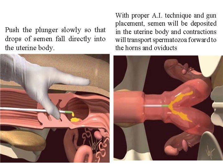 Push the plunger slowly so that drops of semen fall directly into the uterine