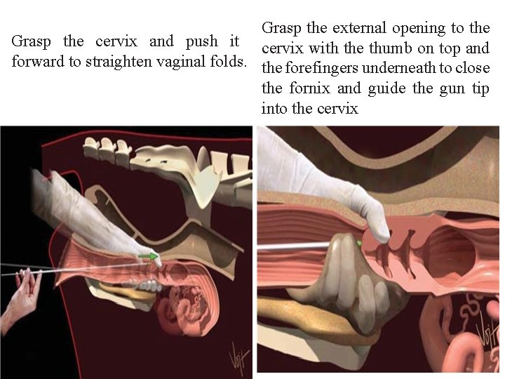 Grasp the external opening to the Grasp the cervix and push it cervix with