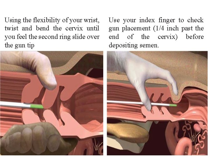 Using the flexibility of your wrist, twist and bend the cervix until you feel