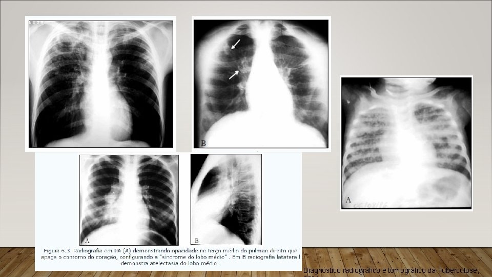 Diagnóstico radiográfico e tomográfico da Tuberculose, 