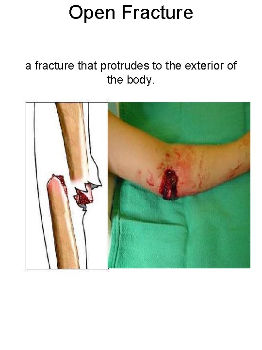 Open Fracture a fracture that protrudes to the exterior of the body. 