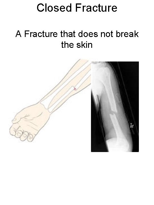 Closed Fracture A Fracture that does not break the skin 