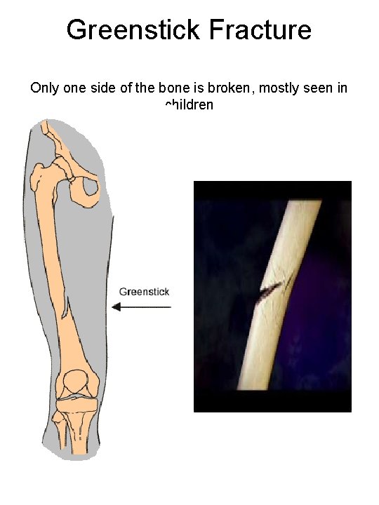 Greenstick Fracture Only one side of the bone is broken, mostly seen in children