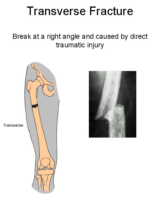 Transverse Fracture Break at a right angle and caused by direct traumatic injury 