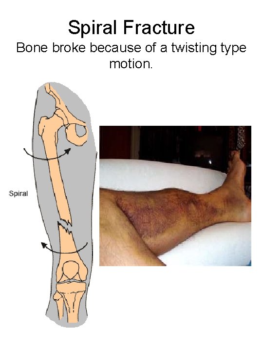 Spiral Fracture Bone broke because of a twisting type motion. 