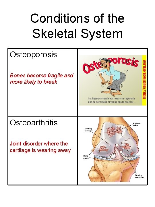 Conditions of the Skeletal System Osteoporosis Bones become fragile and more likely to break
