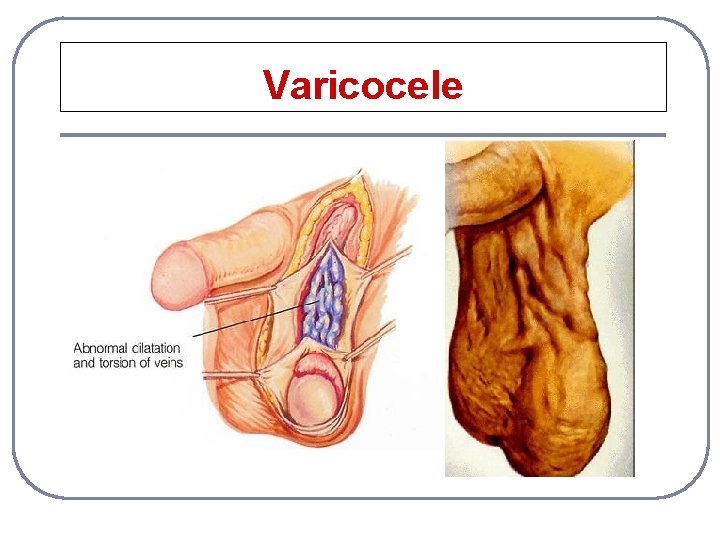 Varicocele 