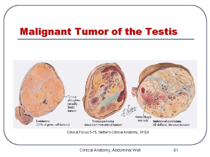 Malignant Tumor of the Testis Clinical Focus 5 -15, Netter’s Clinical Anatomy, 3 rd