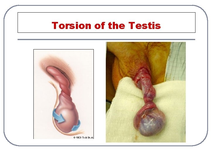 Torsion of the Testis 