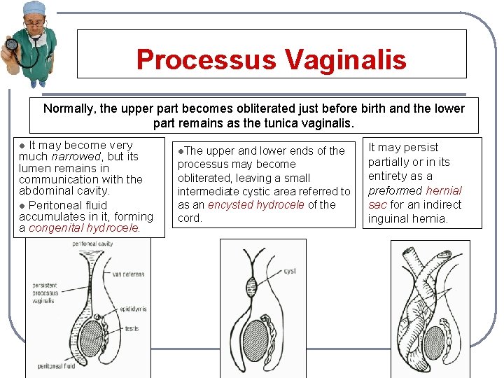 Processus Vaginalis Normally, the upper part becomes obliterated just before birth and the lower