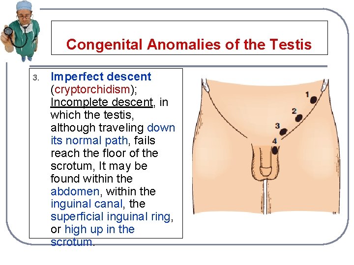 Congenital Anomalies of the Testis 3. Imperfect descent (cryptorchidism); Incomplete descent, in which the