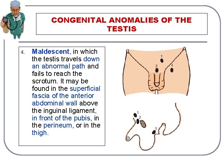 CONGENITAL ANOMALIES OF THE TESTIS 4. Maldescent, in which the testis travels down an
