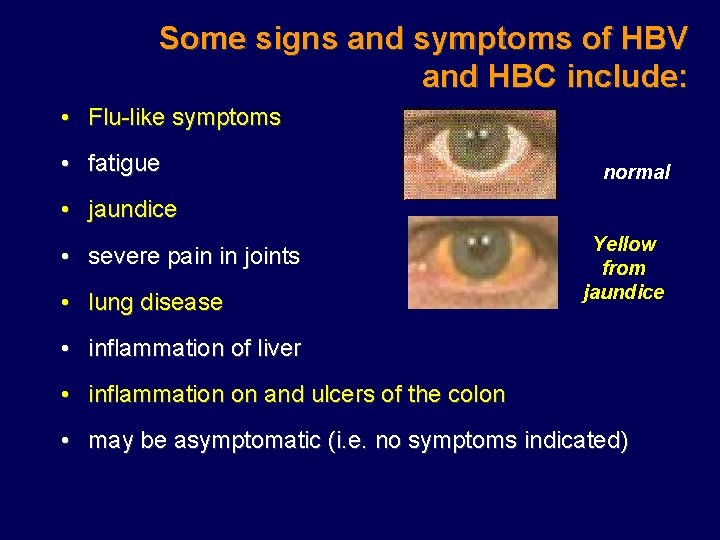 Some signs and symptoms of HBV and HBC include: • Flu-like symptoms • fatigue