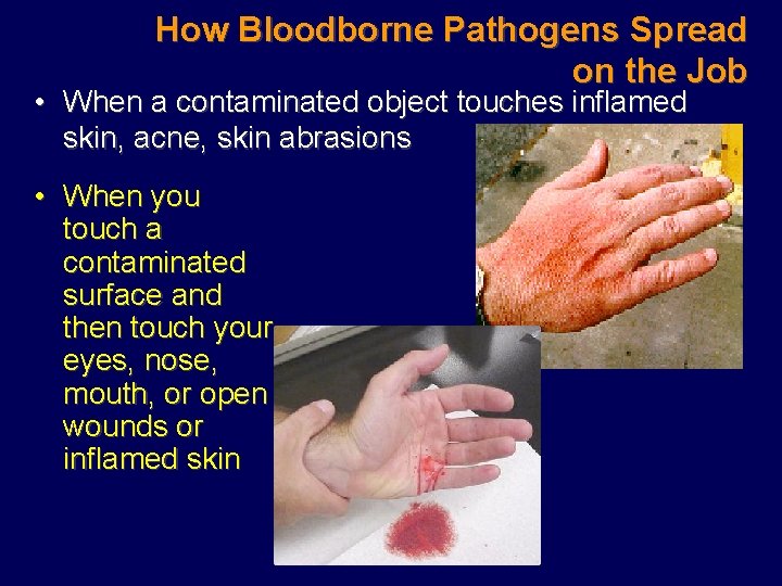 How Bloodborne Pathogens Spread on the Job • When a contaminated object touches inflamed