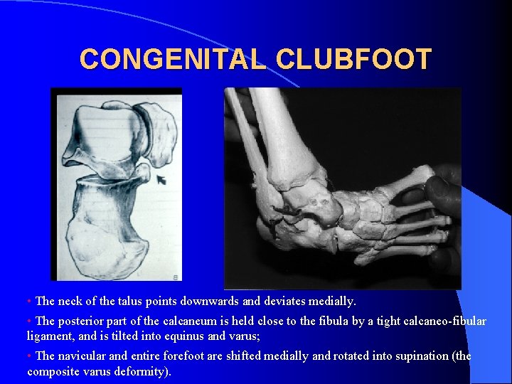 CONGENITAL CLUBFOOT • The neck of the talus points downwards and deviates medially. •