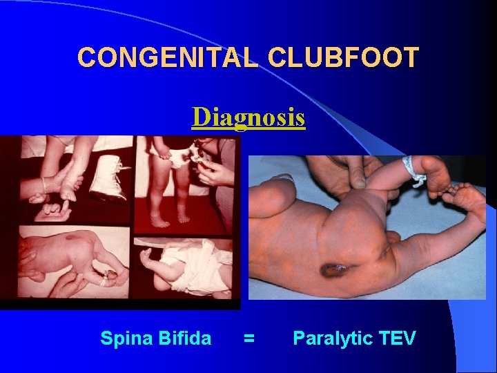 CONGENITAL CLUBFOOT Diagnosis Spina Bifida = Paralytic TEV 