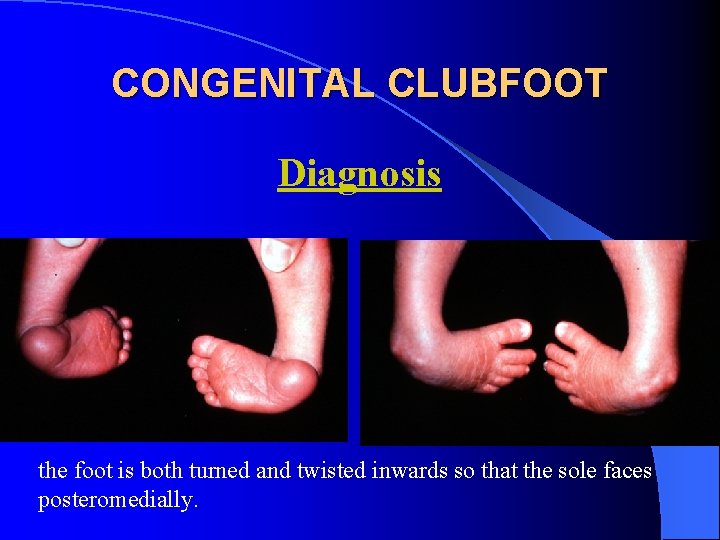 CONGENITAL CLUBFOOT Diagnosis the foot is both turned and twisted inwards so that the