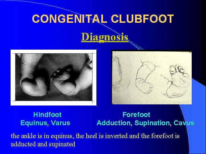 CONGENITAL CLUBFOOT Diagnosis Hindfoot Equinus, Varus Forefoot Adduction, Supination, Cavus the ankle is in