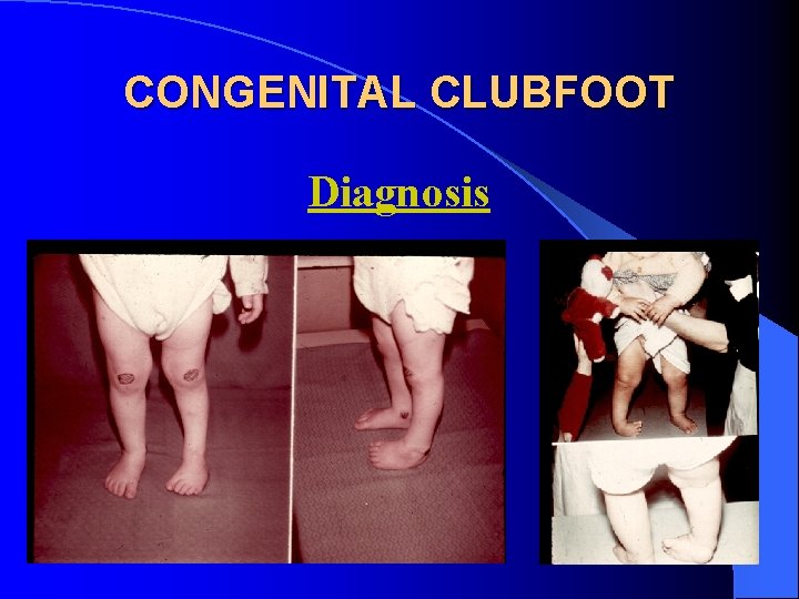 CONGENITAL CLUBFOOT Diagnosis 