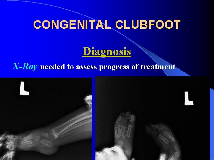 CONGENITAL CLUBFOOT Diagnosis X-Ray needed to assess progress of treatment 