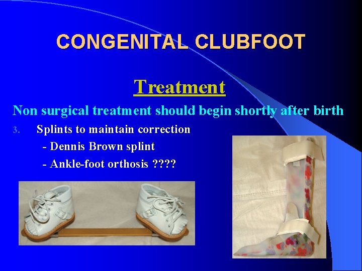 CONGENITAL CLUBFOOT Treatment Non surgical treatment should begin shortly after birth 3. Splints to