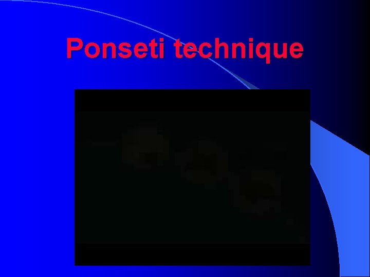 Ponseti technique 