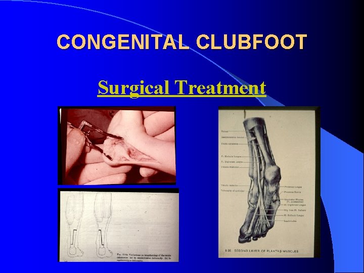 CONGENITAL CLUBFOOT Surgical Treatment 