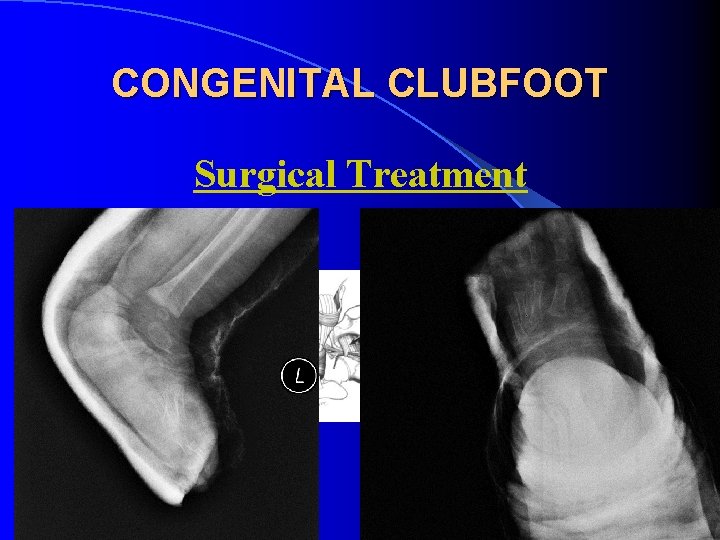 CONGENITAL CLUBFOOT Surgical Treatment 