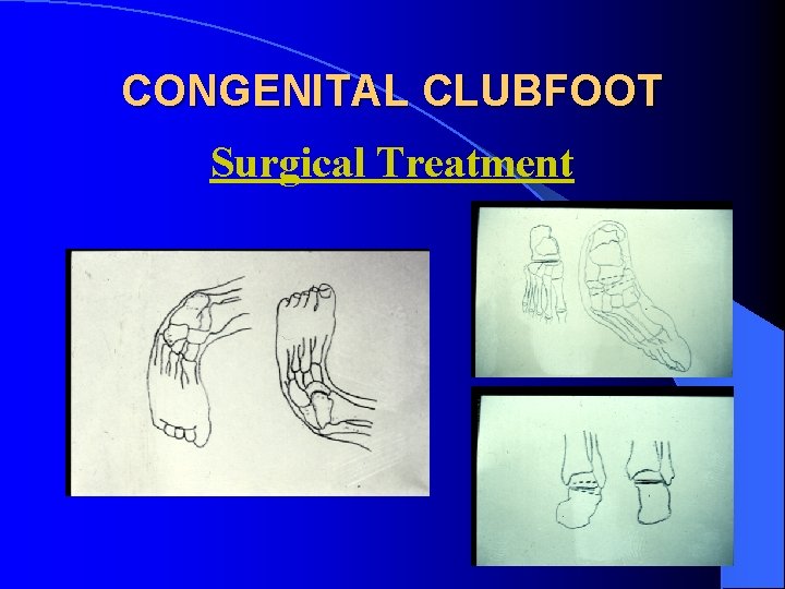 CONGENITAL CLUBFOOT Surgical Treatment 