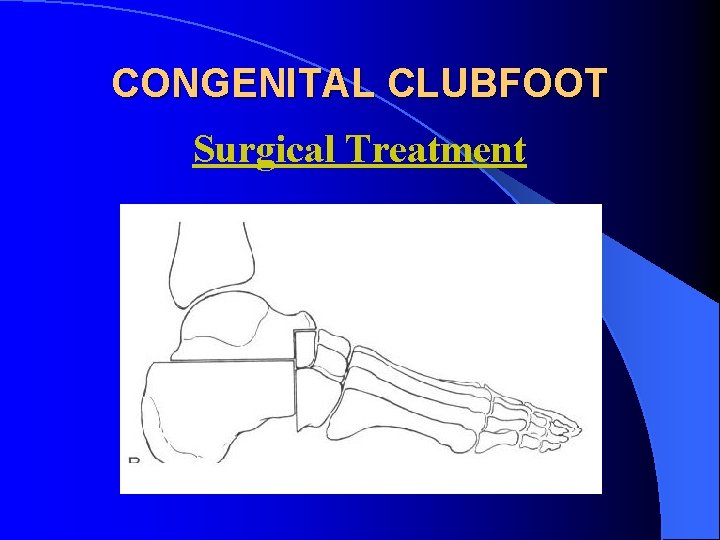 CONGENITAL CLUBFOOT Surgical Treatment 