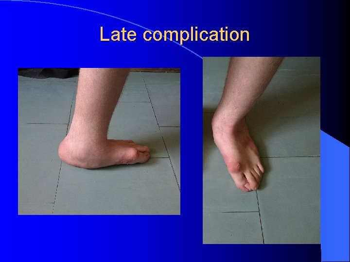 Late complication 