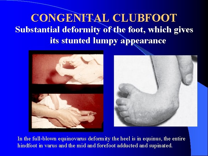 CONGENITAL CLUBFOOT Substantial deformity of the foot, which gives its stunted lumpy appearance In