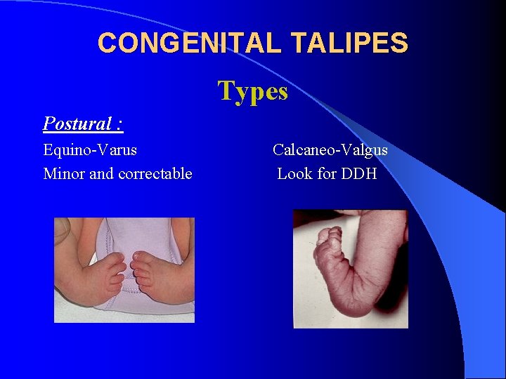 CONGENITAL TALIPES Types Postural : Equino-Varus Minor and correctable Calcaneo-Valgus Look for DDH 