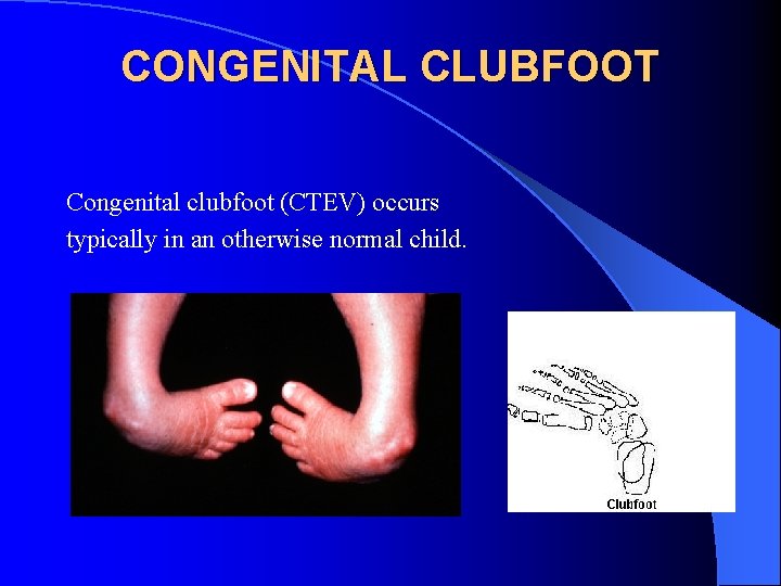 CONGENITAL CLUBFOOT Congenital clubfoot (CTEV) occurs typically in an otherwise normal child. 