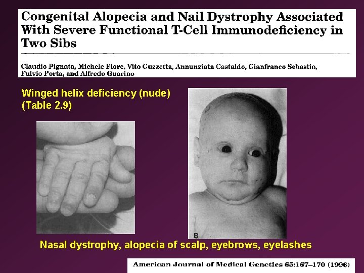 Winged helix deficiency (nude) (Table 2. 9) Nasal dystrophy, alopecia of scalp, eyebrows, eyelashes