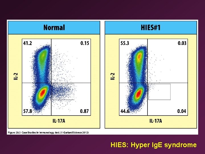 HIES: Hyper Ig. E syndrome 