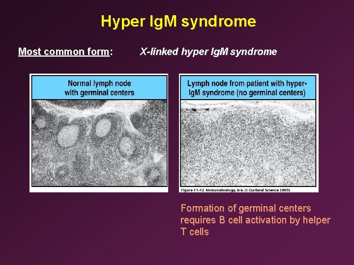 Hyper Ig. M syndrome Most common form: X-linked hyper Ig. M syndrome Formation of