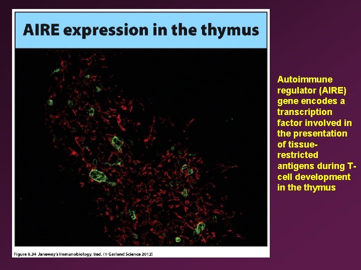 Autoimmune regulator (AIRE) gene encodes a transcription factor involved in the presentation of tissuerestricted