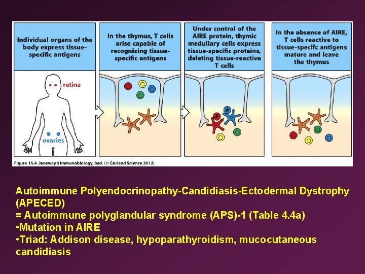 Autoimmune Polyendocrinopathy-Candidiasis-Ectodermal Dystrophy (APECED) = Autoimmune polyglandular syndrome (APS)-1 (Table 4. 4 a) •