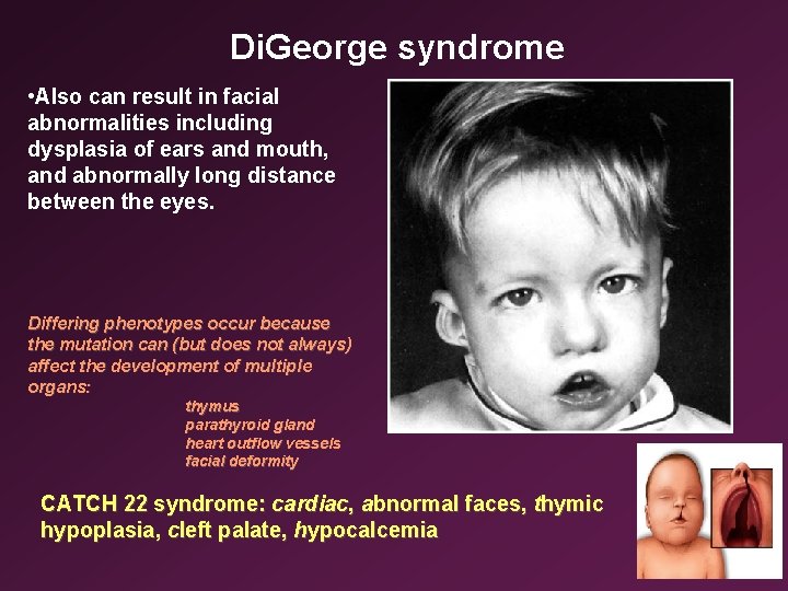 Di. George syndrome • Also can result in facial abnormalities including dysplasia of ears