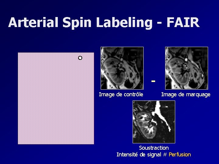 Arterial Spin Labeling - FAIR Image de contrôle Image de marquage Soustraction Intensité de